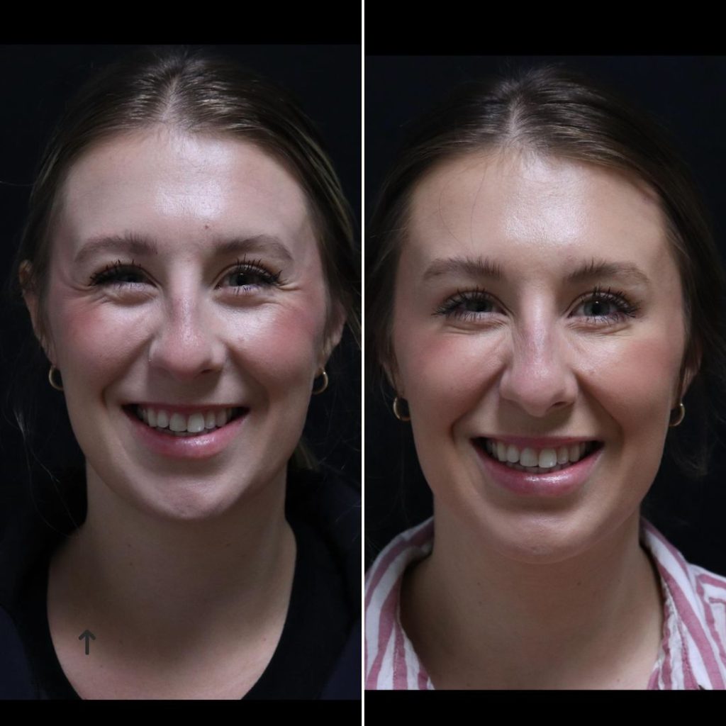 Before and after Botox treatments London results