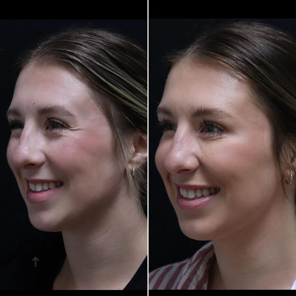 Before and after Botox treatments London results