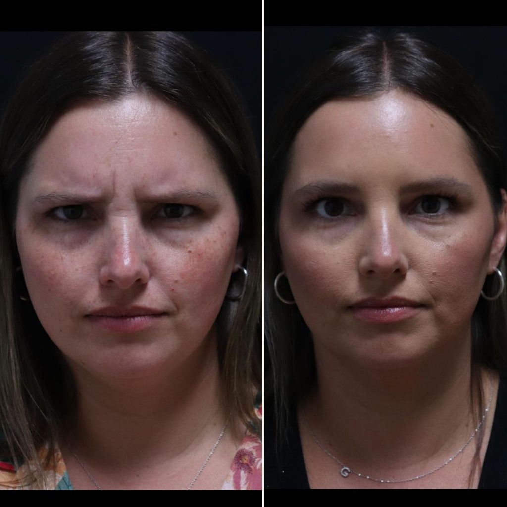 Before and after Botox treatments London results