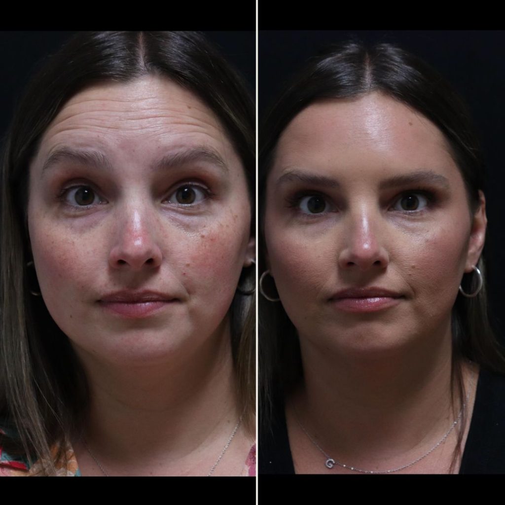 Before and after Botox treatments London results