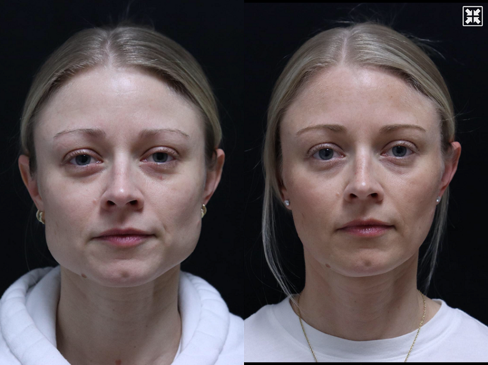 Before and after Botox treatments London results